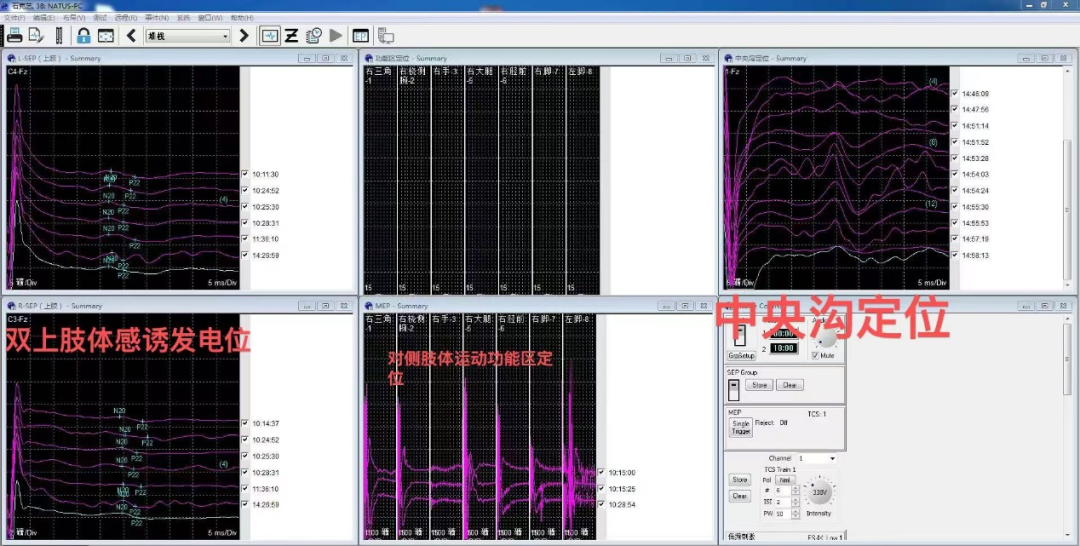 小妲己直播app
应用神经电生理监测技术辅助精准切除脑肿瘤
