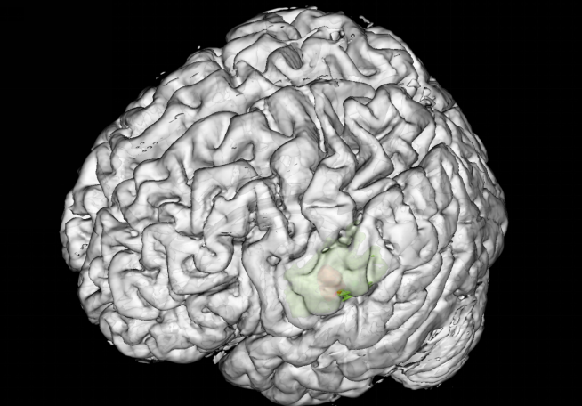 小妲己直播app
神经外科完成首例术中唤醒脑功能区癫痫病灶切除手术