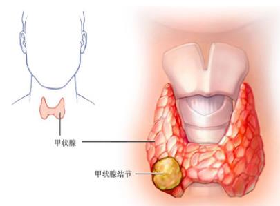 甲状腺结节不要慌，多模态超声来帮忙