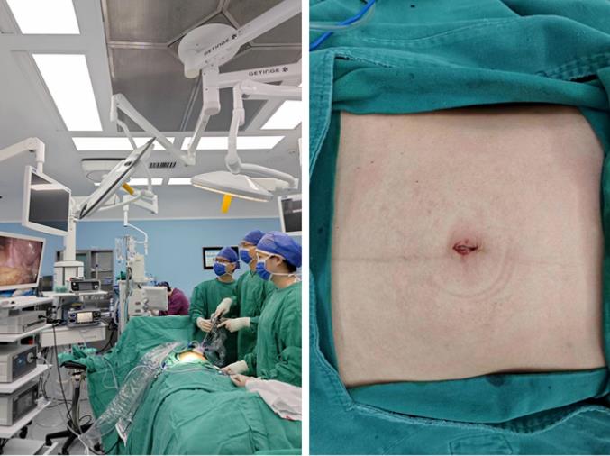 小妲己直播app
单孔腹腔镜术助患者实现“术后无痕”