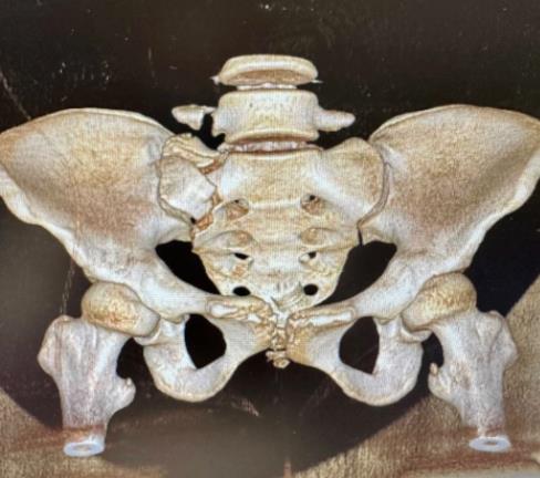 小妲己直播app
骨折微创固定技术大显身手