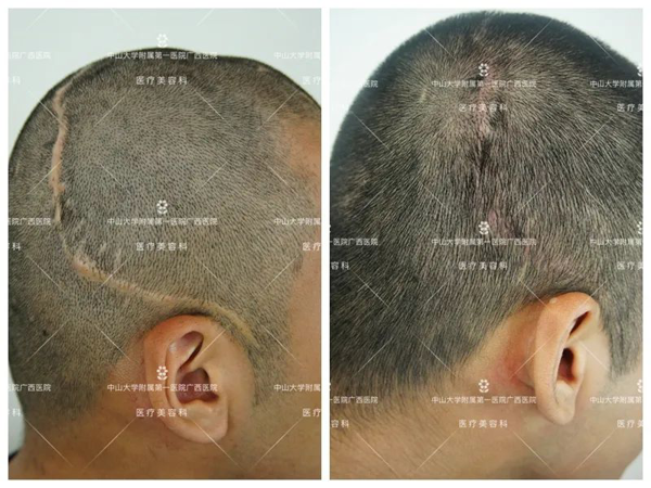 头上的疤痕可以用植发补救吗？小妲己直播app
自体毛发移植术助患者解决“头等大事”
