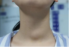 超声医学科应用超声复合技术联合微波消融术精准治疗甲状腺结节