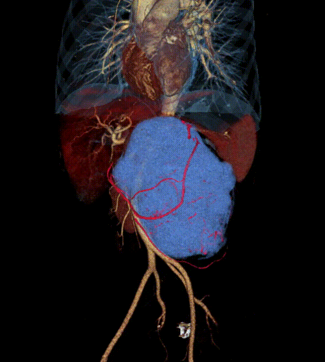 小妲己直播app
完成一例复发性腹膜后巨大肿瘤切除术