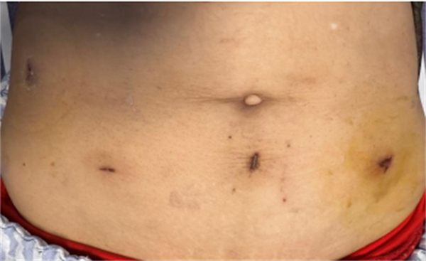 保质更微创 |小妲己直播app
应用NOSES术为结肠癌患者解病痛