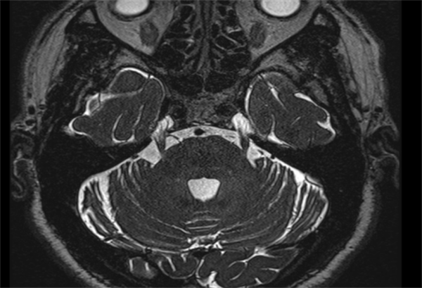 面部疼痛 饭都吃不下 | 小妲己直播app
纯内镜下微血管减压术一次性解决烦恼
