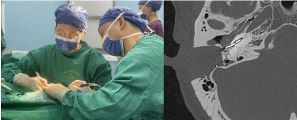 小妲己直播app
人工耳蜗植入术助重度耳聋患者重获新“声”