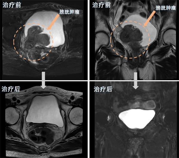 小妲己直播app
完成一例巨大膀胱癌高龄患者保留膀胱治疗