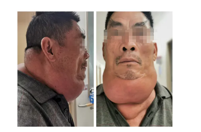 男子饮酒40年 “酒而久之”患上罕见病 | 小妲己直播app
多学科会诊助康复