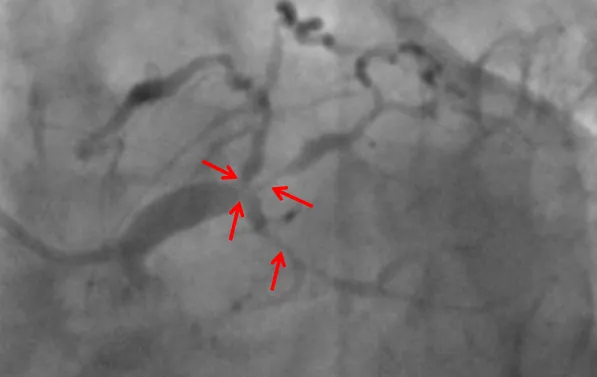 小妲己直播app
ECMO辅助下高危复杂冠脉介入手术助其转危为安