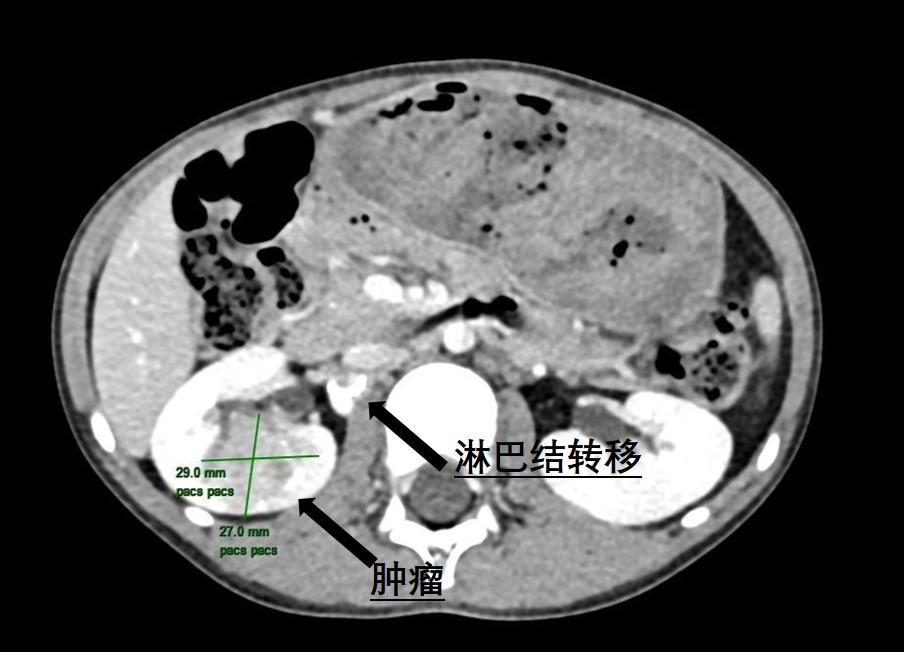 6岁患儿肾脏暗藏罕见肿瘤 | 小妲己直播app
泌尿外科精准手术“摘瘤”
