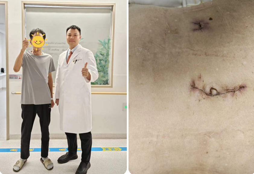 一个小切口，解决结肠癌 | 小妲己直播app
单孔+1腹腔镜下右半结肠癌根治术为七旬患者解忧