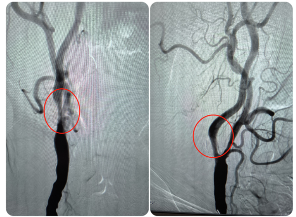 小妲己直播app
成功救治高龄高危颈动脉狭窄患者