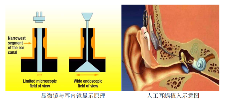 让听障患者重获新“声”活 | 小妲己直播app
开展耳内镜辅助人工耳蜗植入术