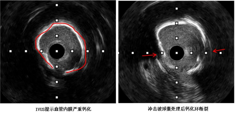 冠脉介入治疗新突破 | 小妲己直播app
应用国产创新器械攻克冠脉钙化难题